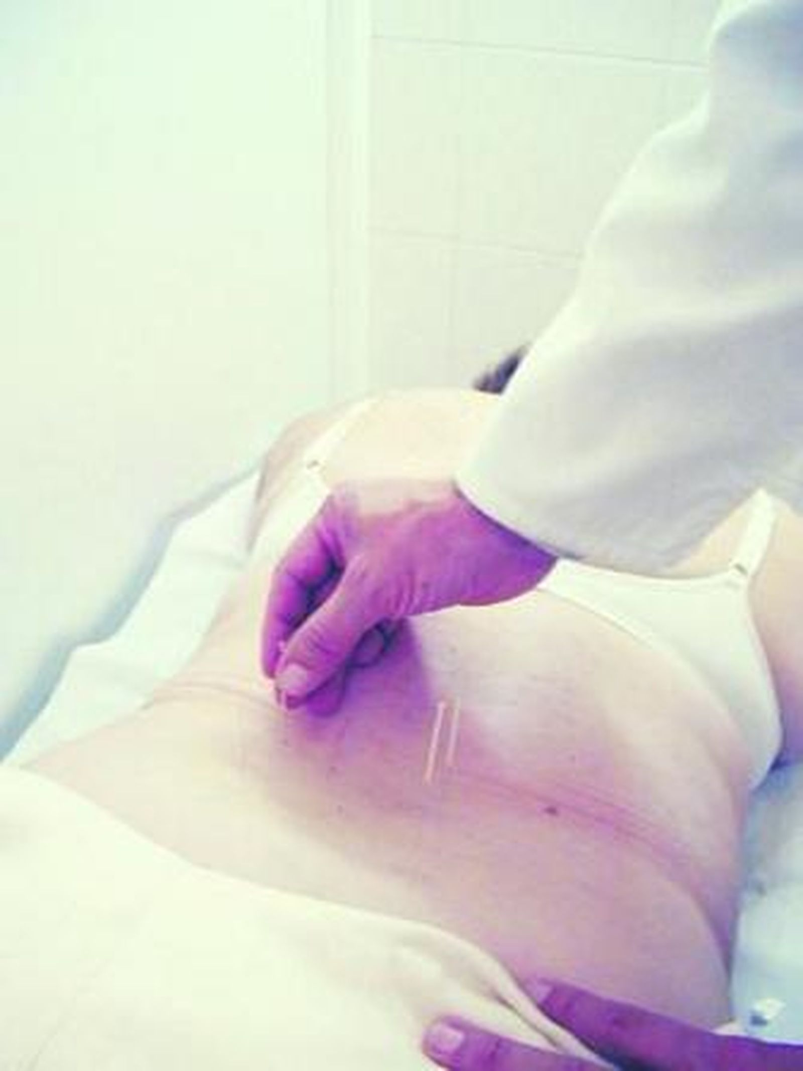 El médico especialista trata con agujas el dolor a una paciente.