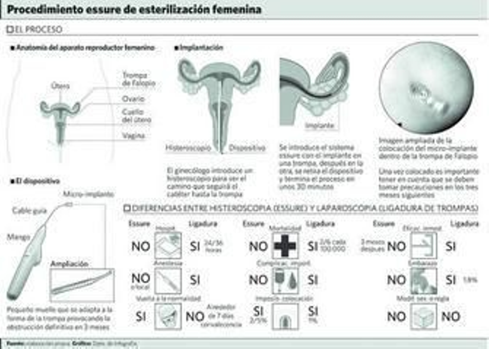 El Clínico incorpora una nueva técnica de esterilización femenina ambulatoria