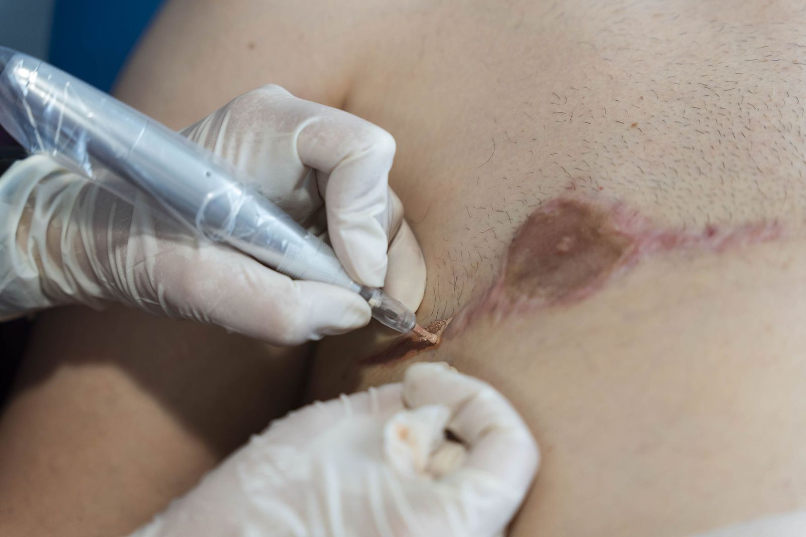 Un tratamiento de micropigmentación por mastectomía en un hombre, en imágenes