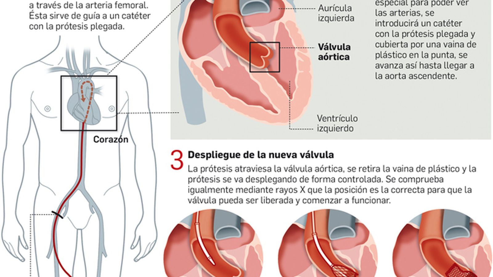 La intervención paso a paso