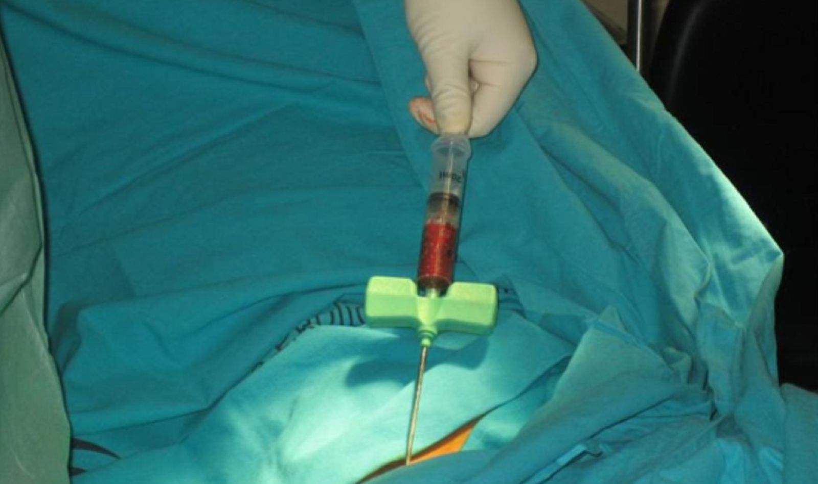 Proceso de extracción de células madre