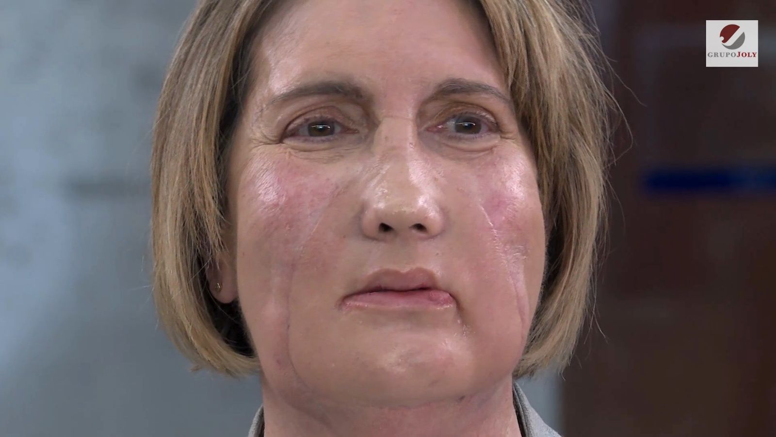 Realizado en España el primer trasplante de cara del mundo con donante por eutanasia