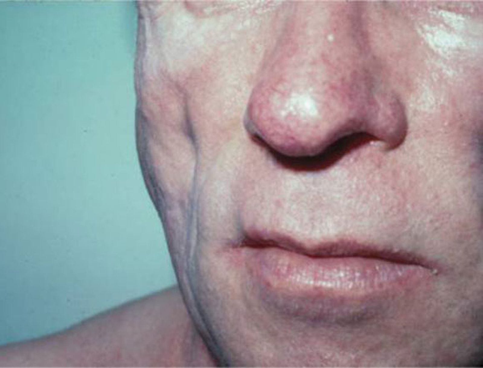 La lipodistrofia marca la carrera laboral de muchas mujeres con VIH