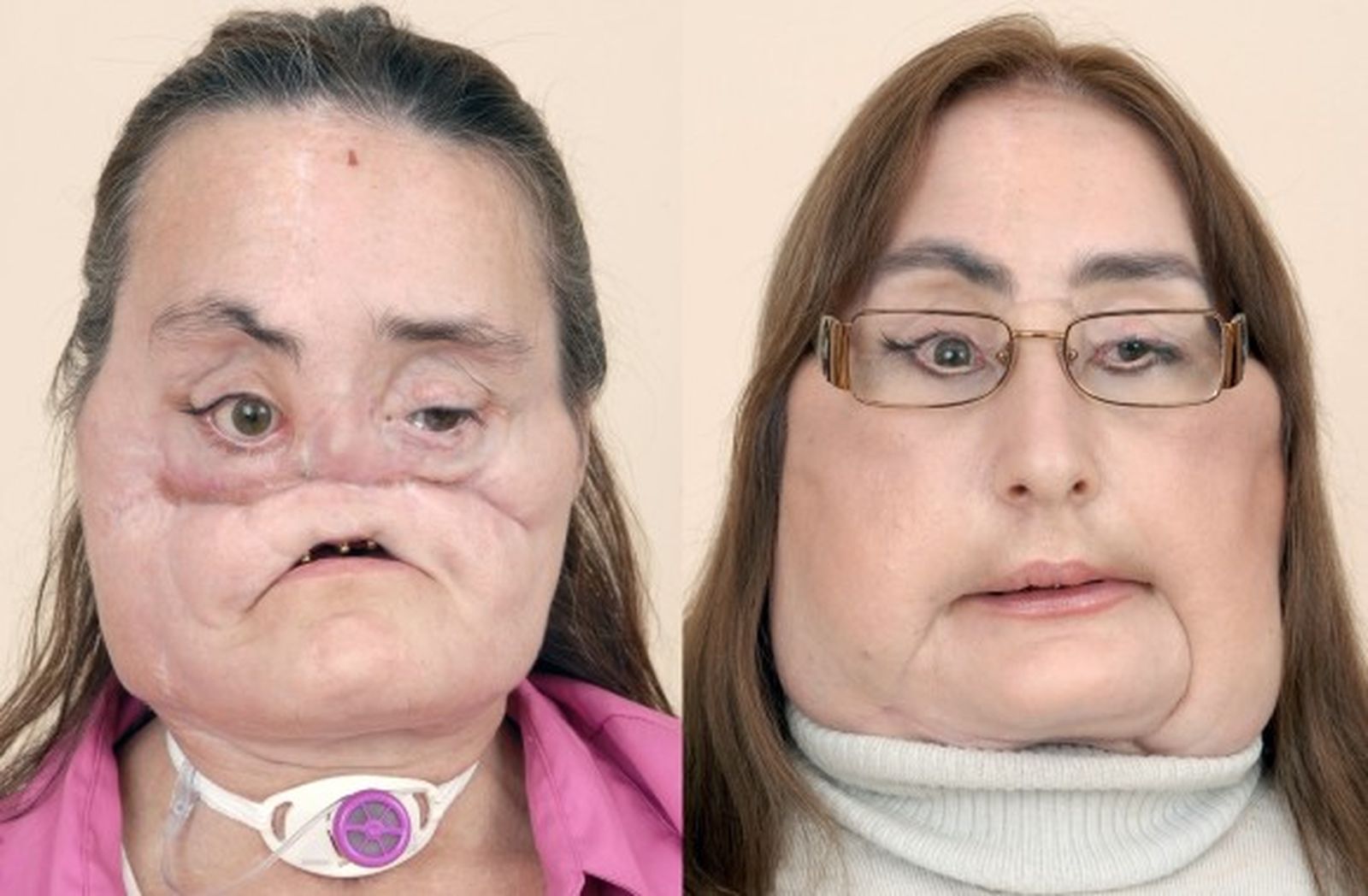 Presentan a una paciente con la cara trasplantada casi por completo