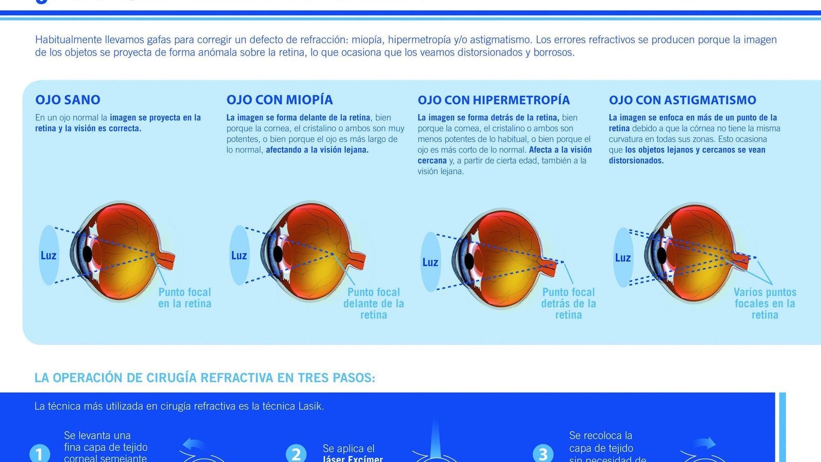 ¿Por qué necesito gafas?