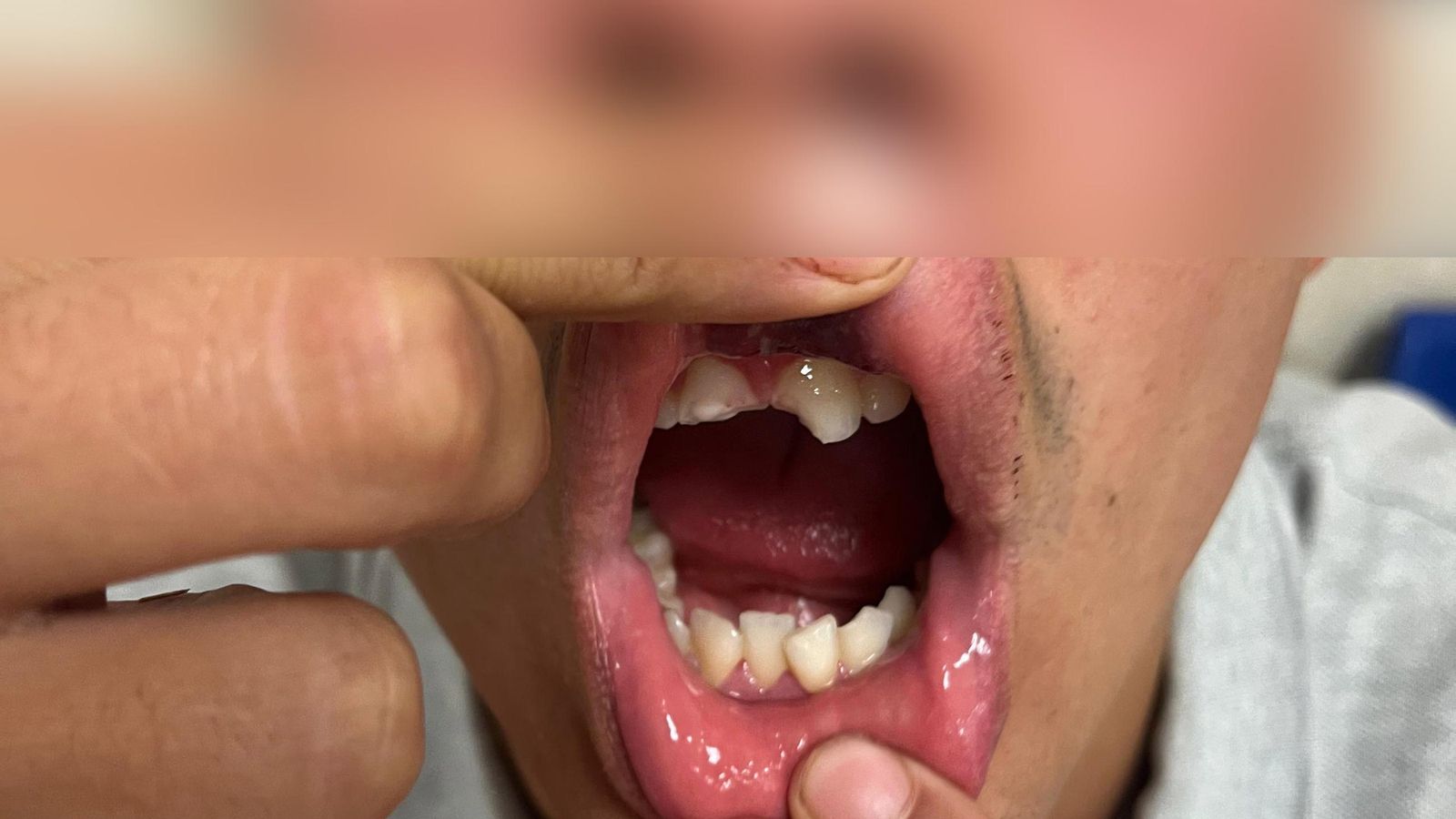 El joven agredido sufrió la pérdoda de dos piezas dentales