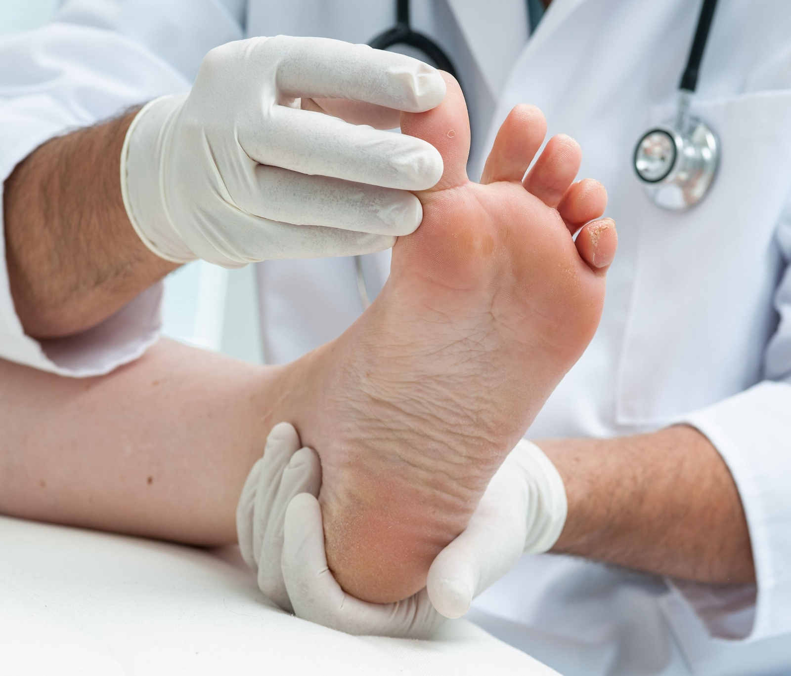 Es un tipo de artritis que causa dolor y rigidez en las articulaciones y suele aparecer primero en el pie.