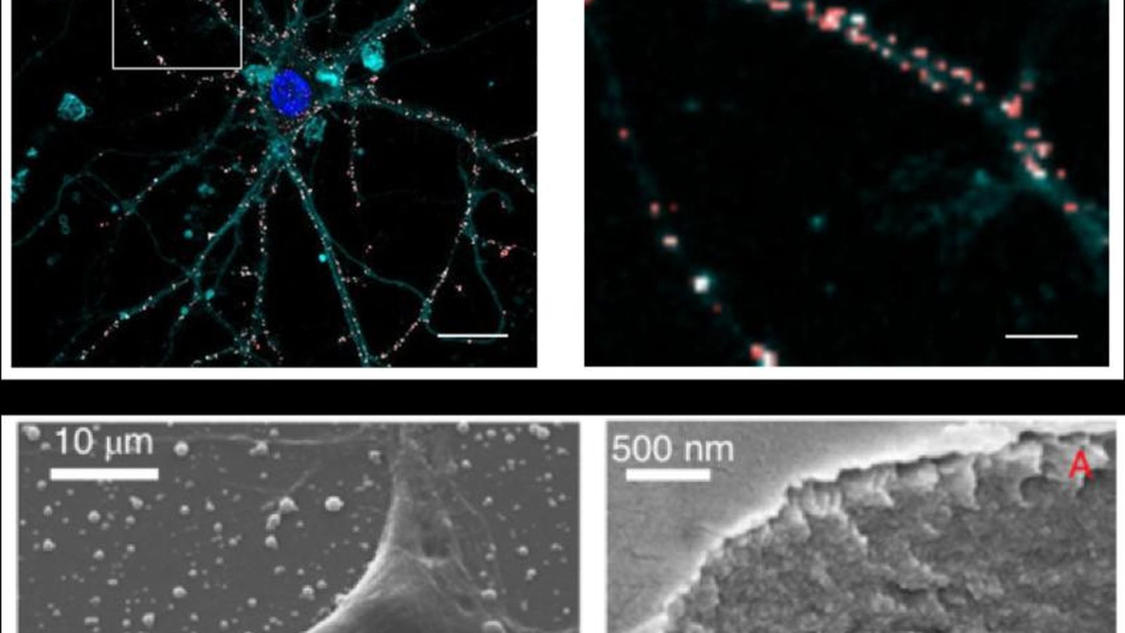 Panel superior: Imagen de microscopía confocal fluorescencia que muestra nanopartículas (en rojo) depositadas en las membranas neuronales (en azul marino) sin ingresar a las células. Panel inferior: imagen de microscopía electrónica de barrido que muestra una neurona sobre una capa de nanopartículas y la sección de una célula cuya membrana se ha conformado con la presencia de una nanopartícula no internalizada.