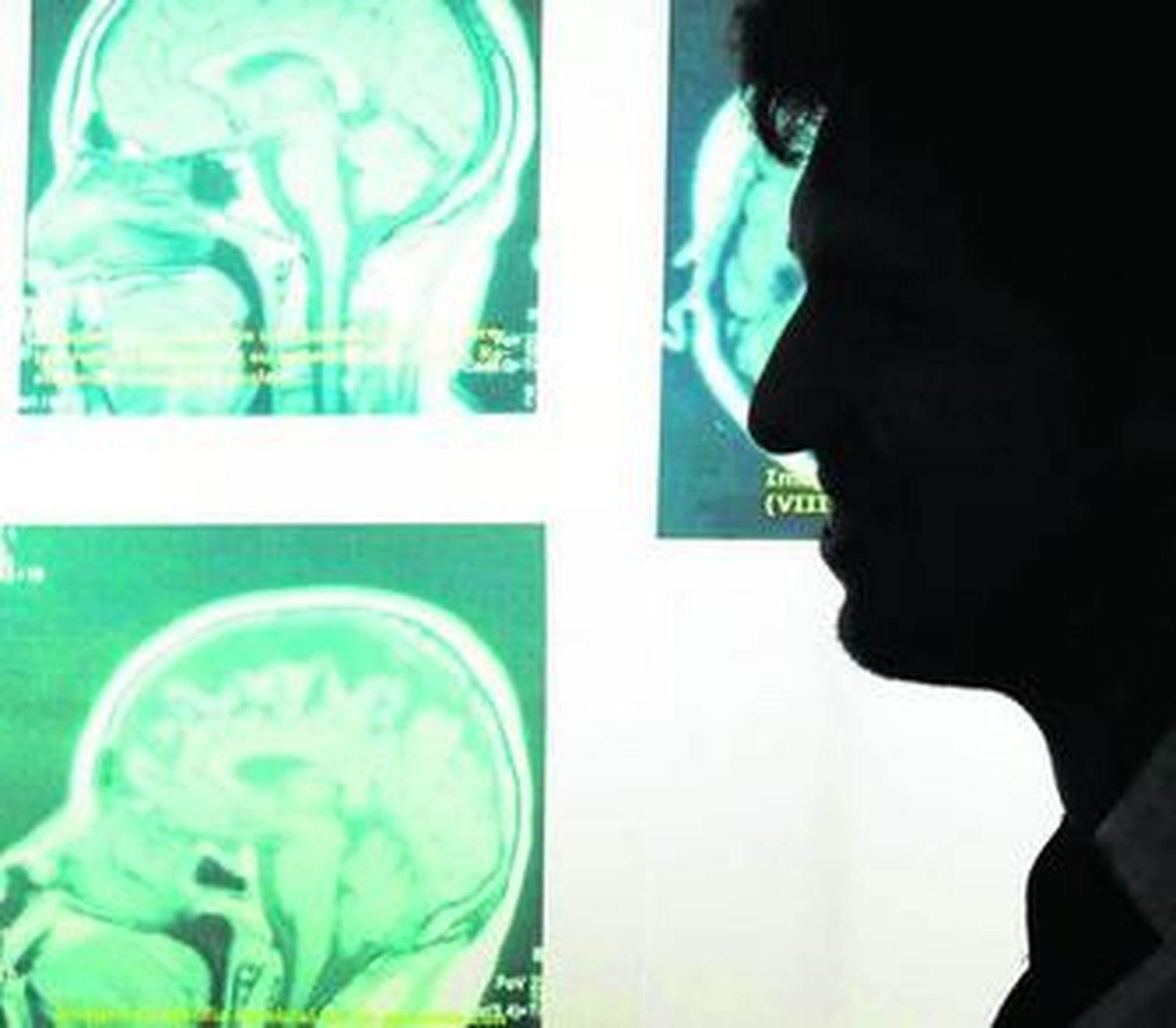 Imágenes del estudio de patologías cerebrales.