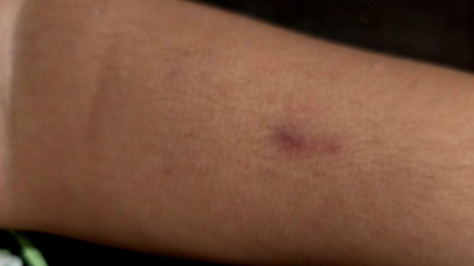 Otra fotografía del brazo del menor.