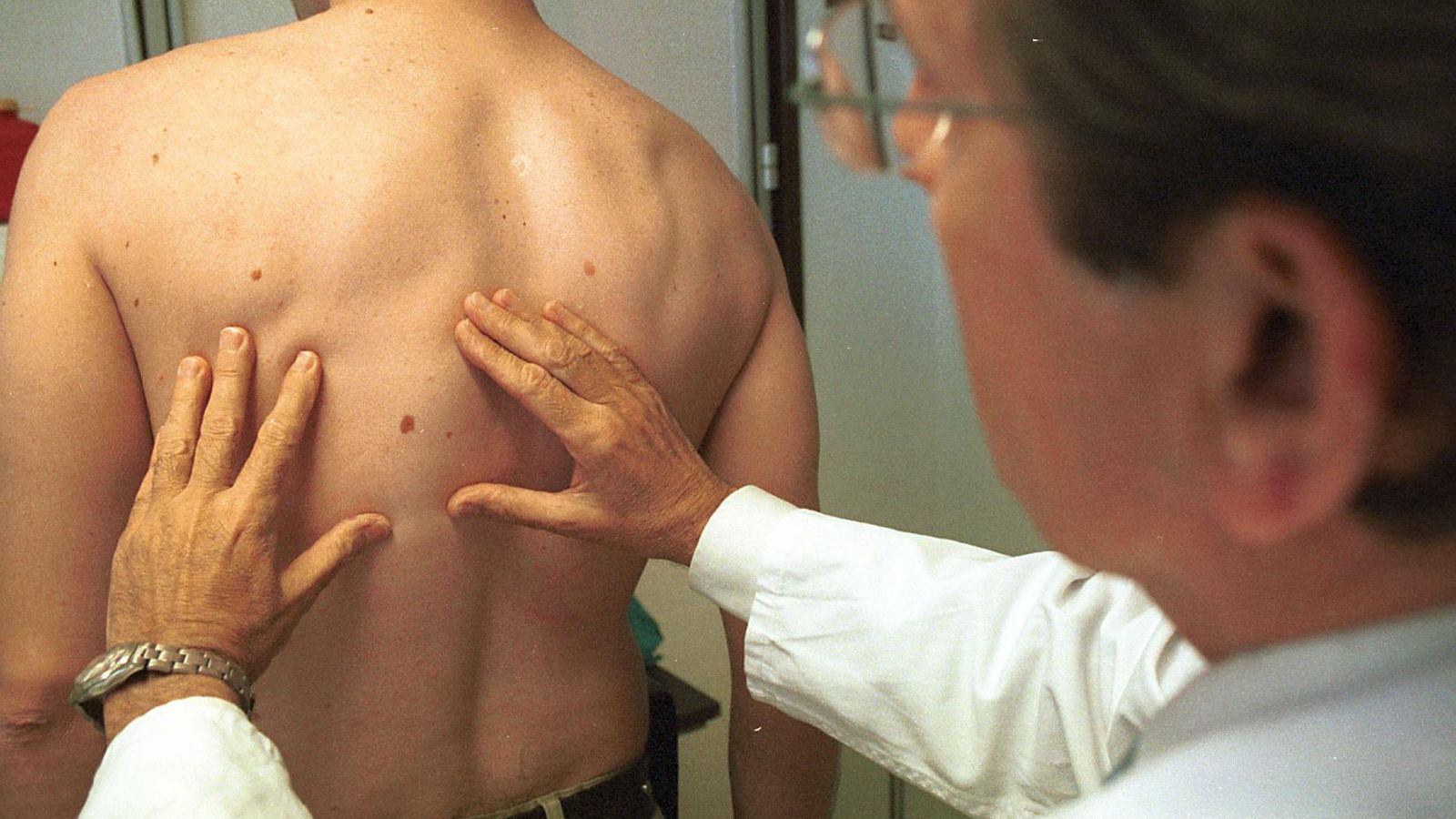 Médico examinando un melanoma
