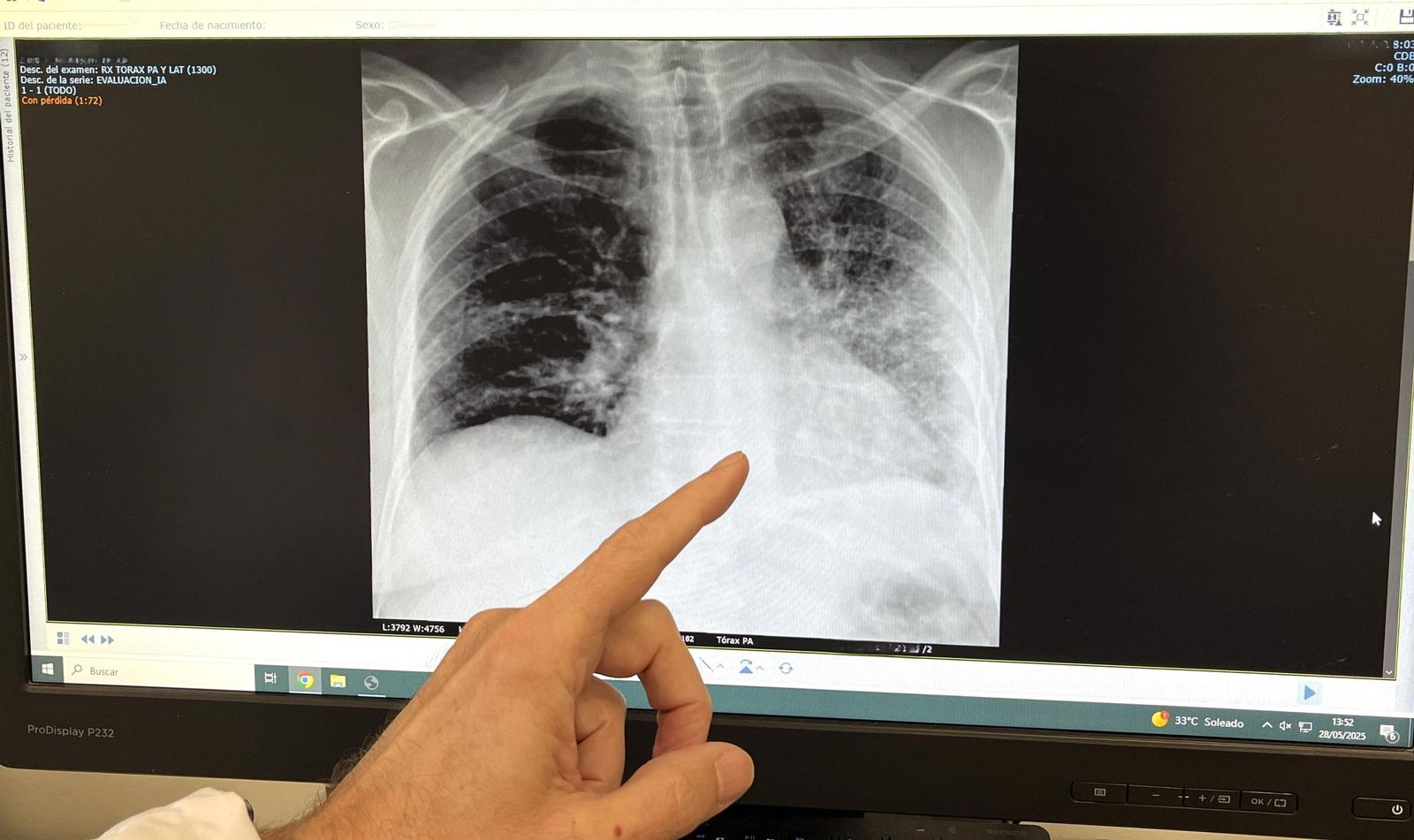 El tórax de un paciente fumador con cáncer de pulmón.