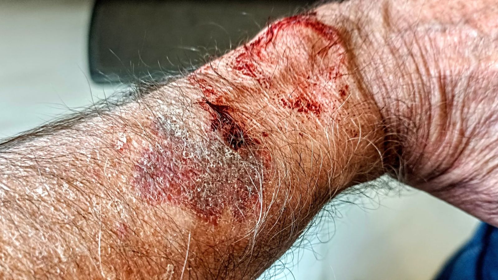 La herida que sufrió en el brazo el denunciante Javier Arribas.