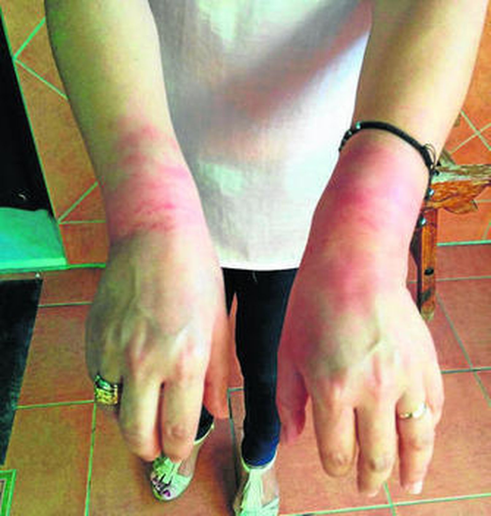 La víctima muestra los hematomas en las manos.