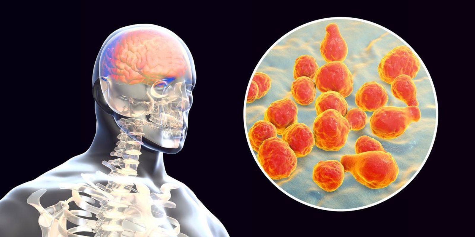 Meningitis: síntomas, riesgos y cómo reconocerla a tiempo