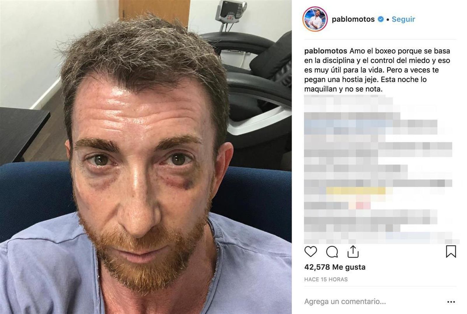 Foto de Pablo Motos con el ojo morado