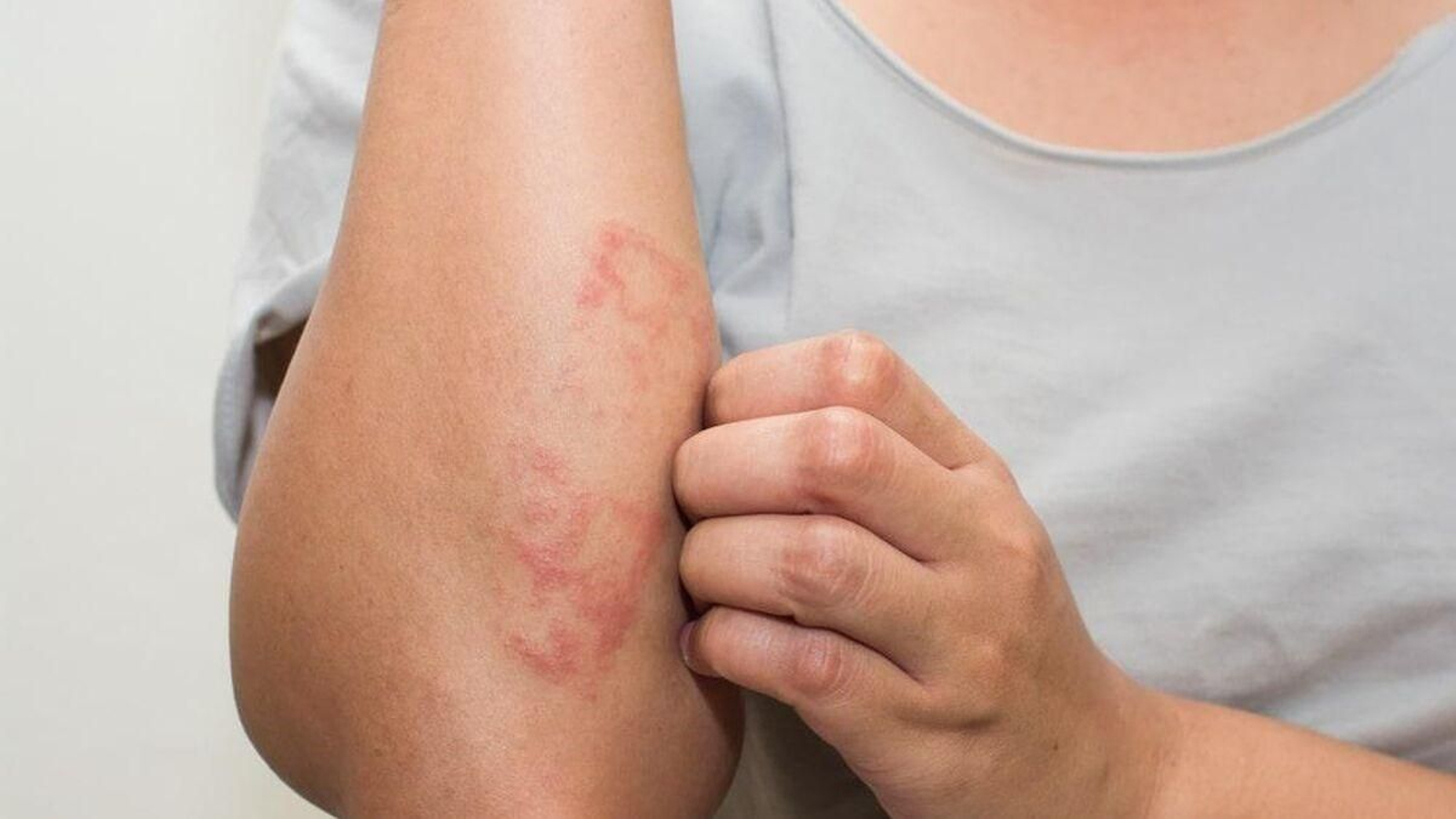 Imagen de archivo de una persona contagiada de sarna.