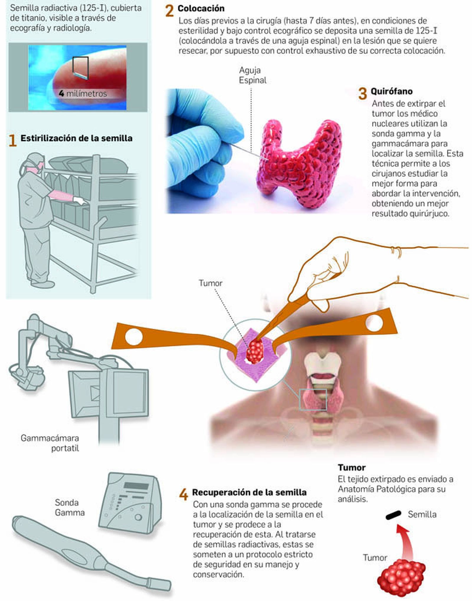Nueva técnica en la cirugía de rescate del cáncer diferenciado de tiroides.