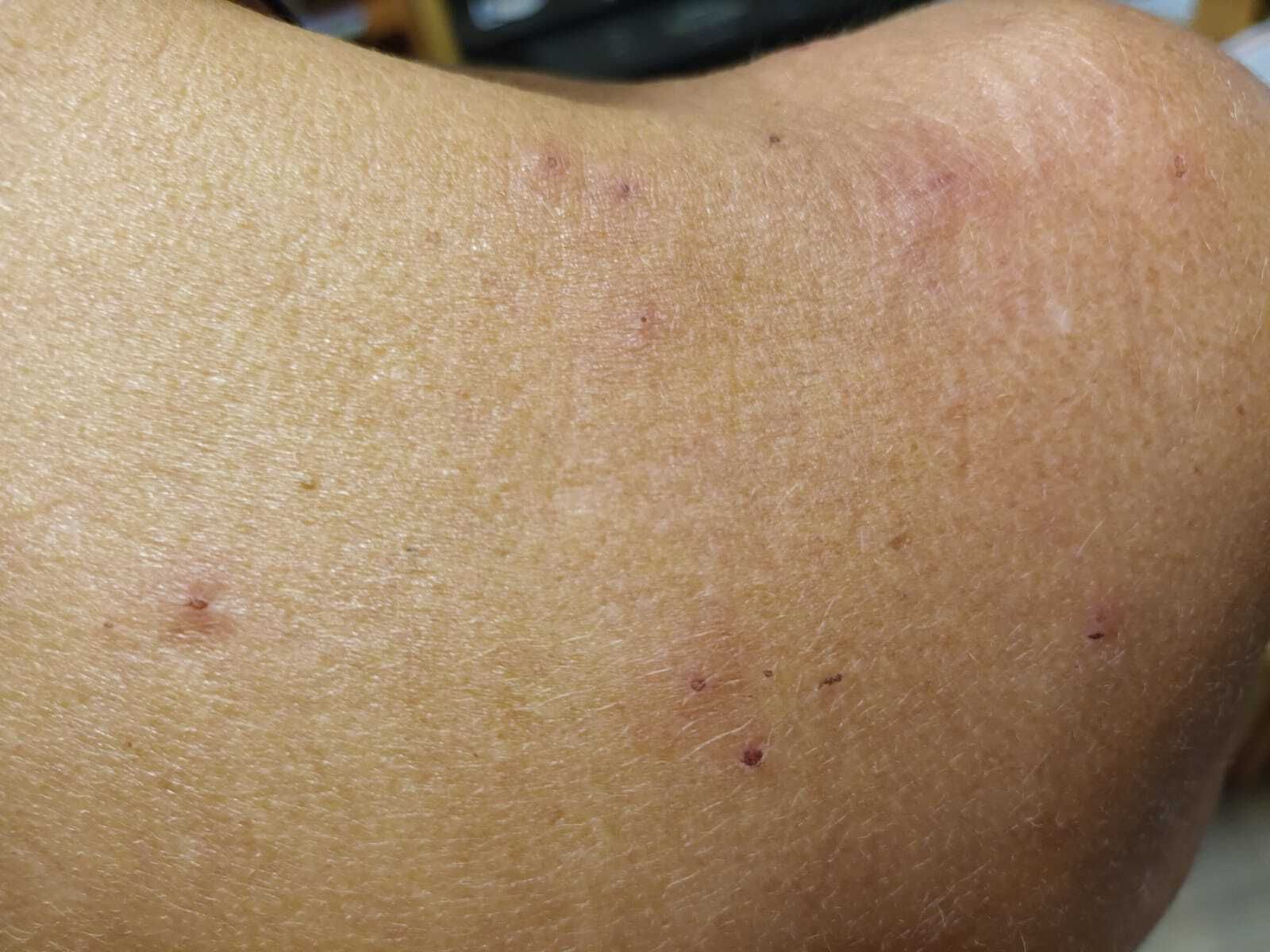 El brazo de uno de los funcionarios donde se aprecian las picaduras.