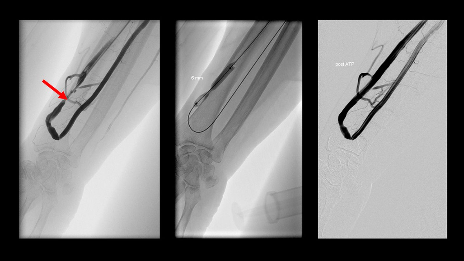 Imagen radiológica antes, durante y después del tratamiento de la estrechez de una fístula de un paciente en la Sala de Radiología Vascular del Hospital Universitario Juan Ramón Jiménez.