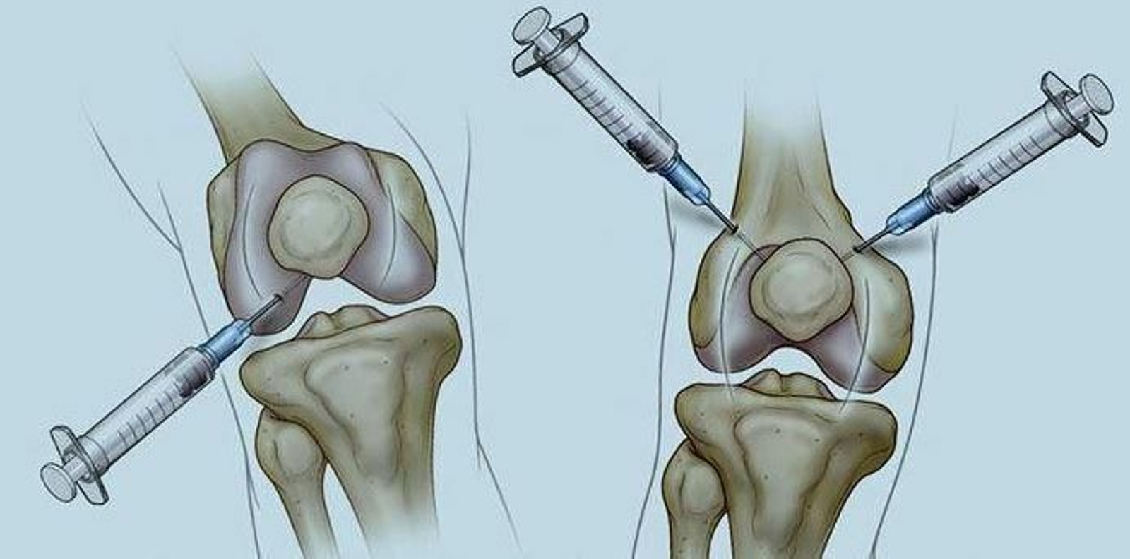 Dibujo de una infiltración de rodilla.