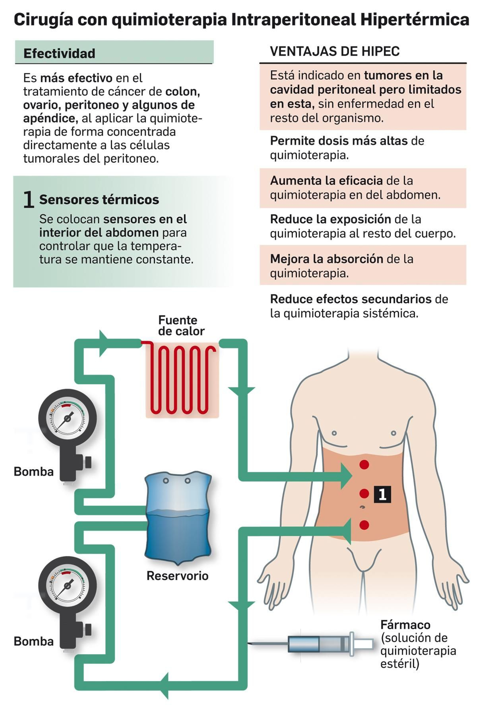 Cirugía con quimioterapia intraperitoneal hipertermica.
