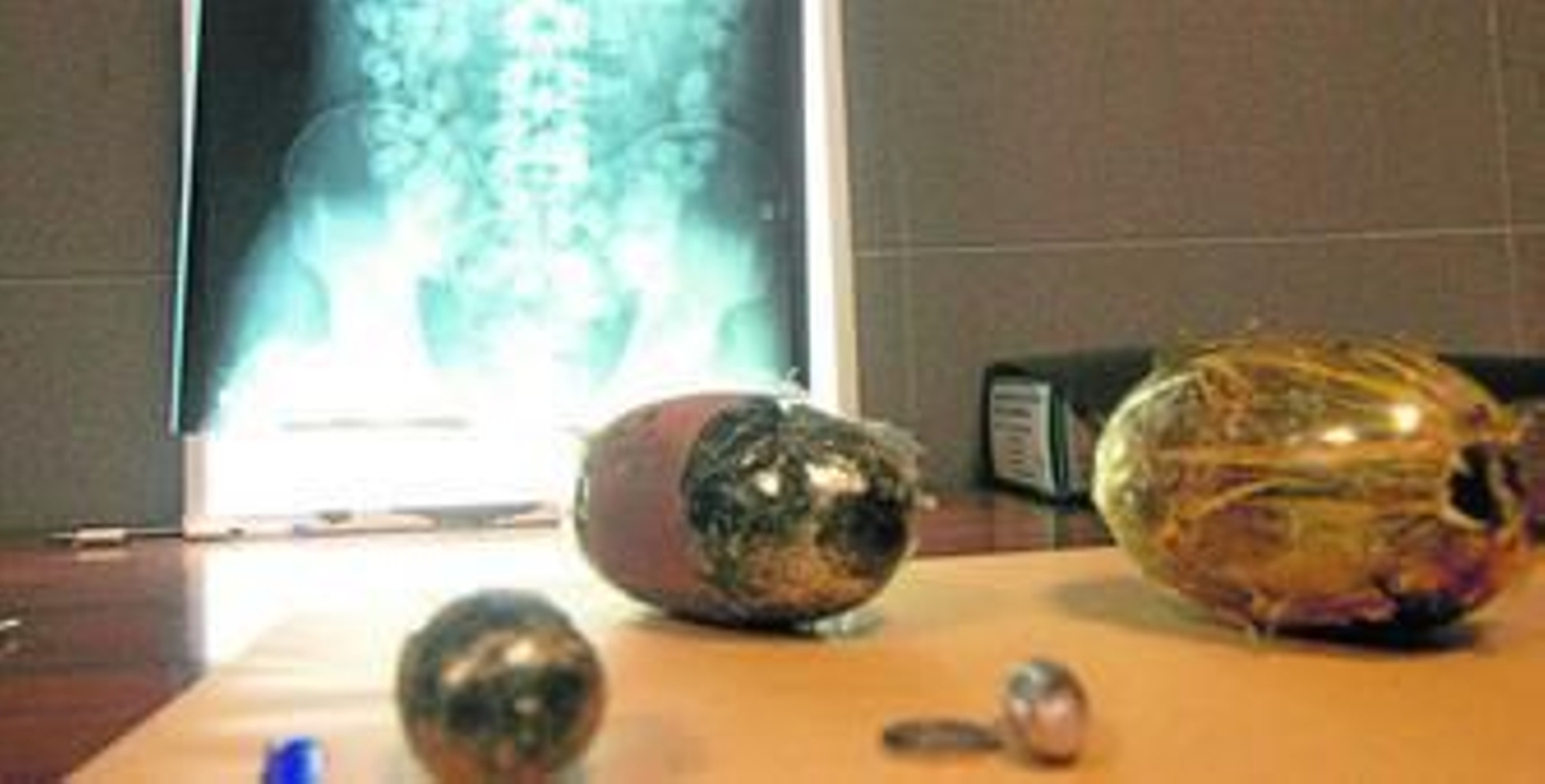 Otra radiografía en la que se comprueba un organismo repleto de pequeñas bellotas.