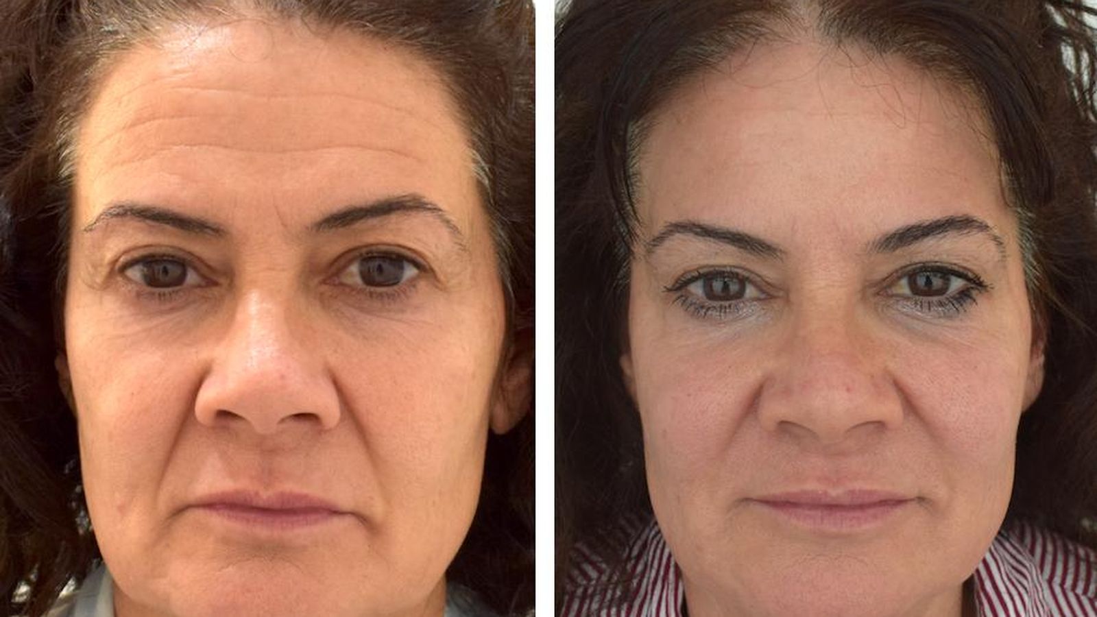 Rejuvenecimiento global del rostro con técnica 4x9 sin cirugía Dr. Kosmecki (Clínicas Verkomed).