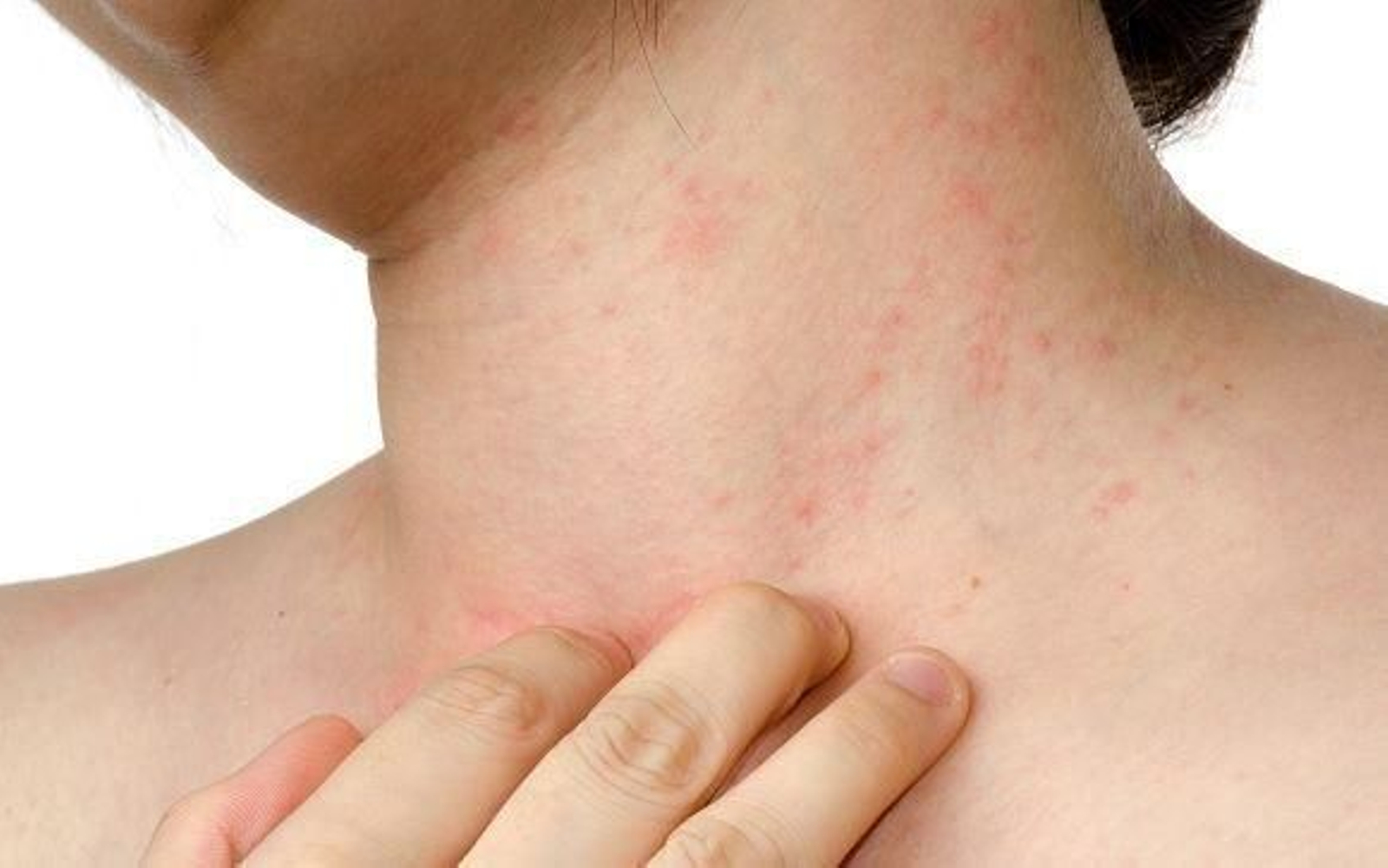 Ejemplo de dermatitis atópica en un menor.