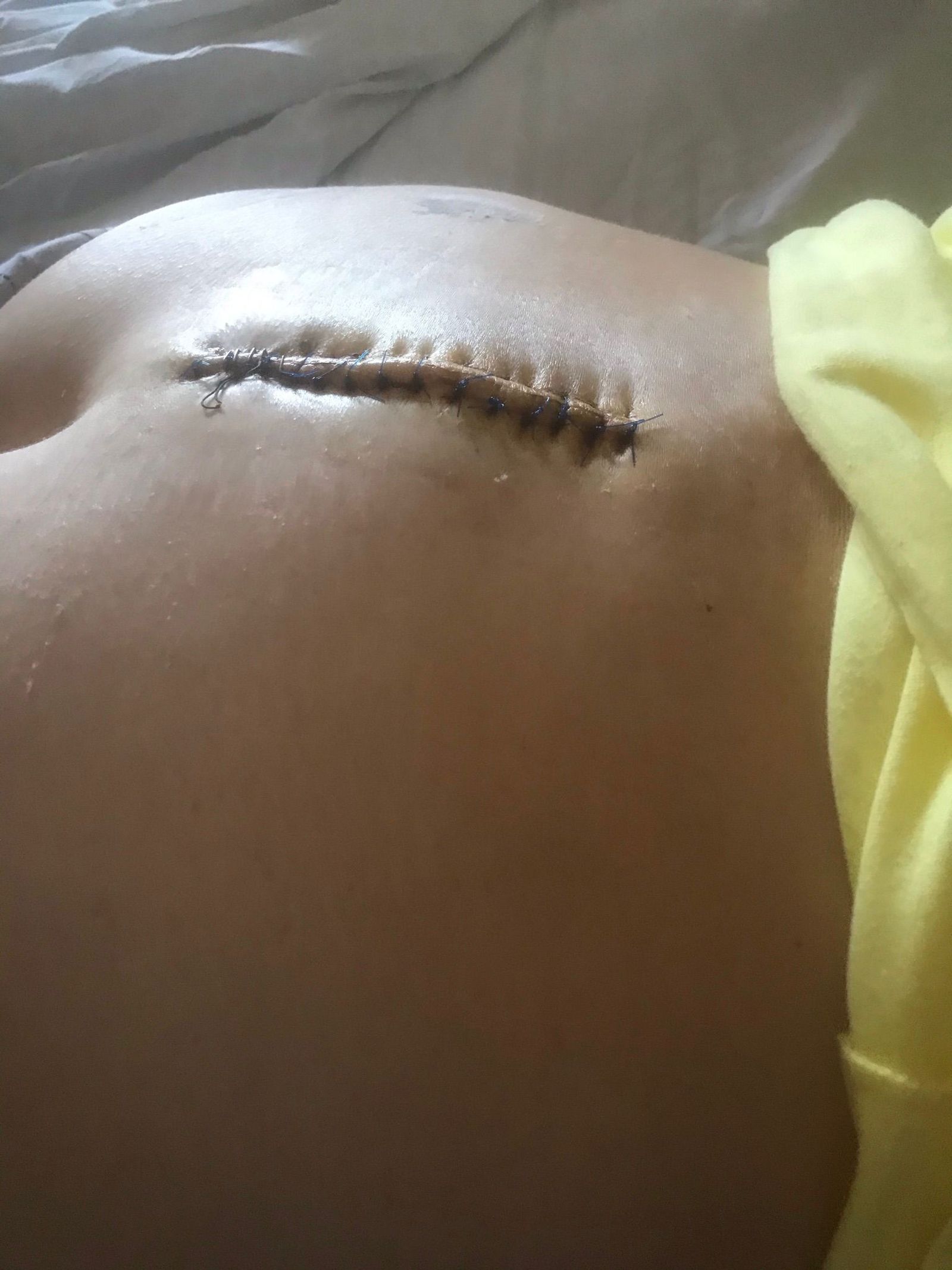 Cicatriz de la otra operación.