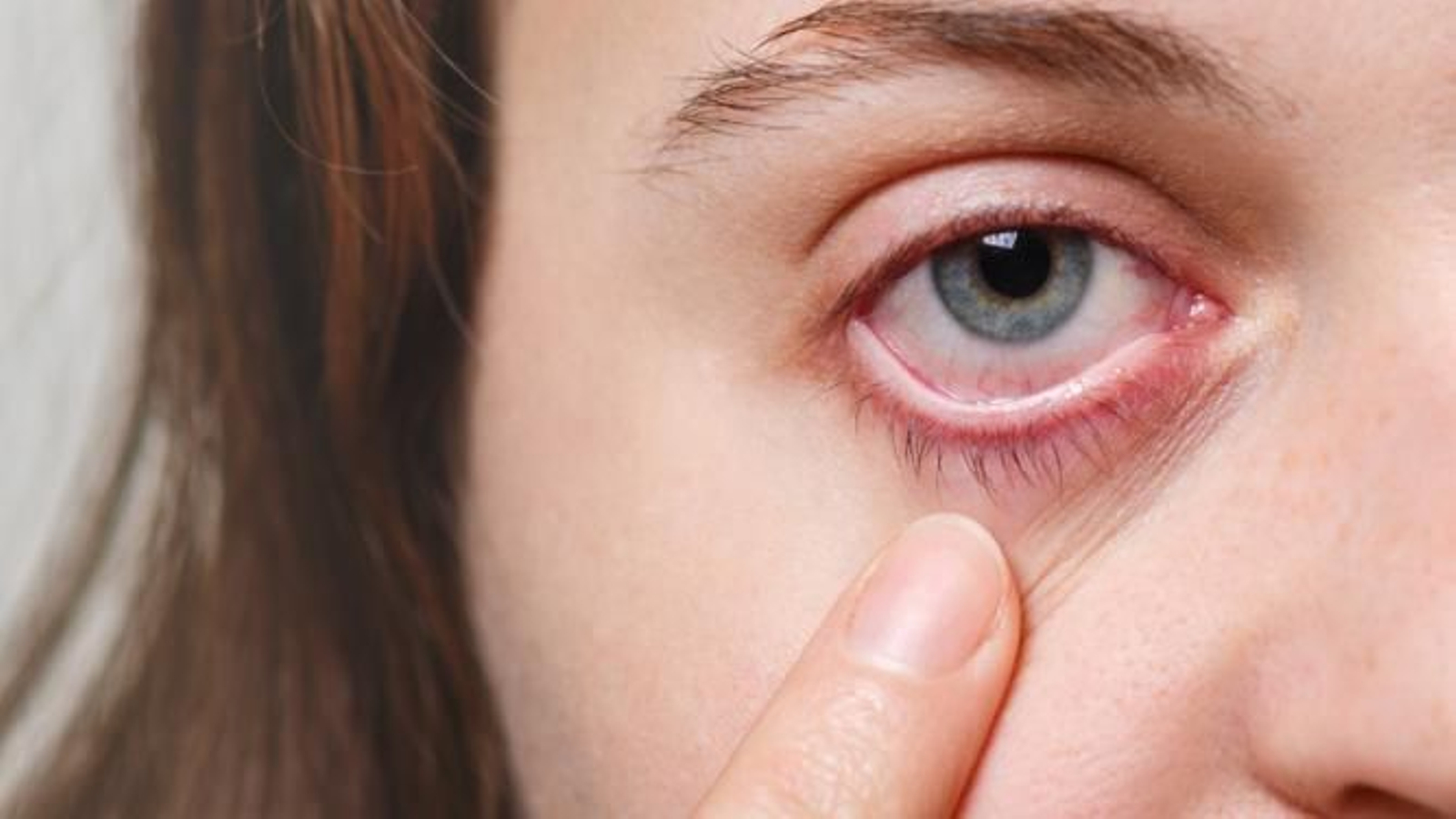 Estas son las enfermedades más comunes de los párpados