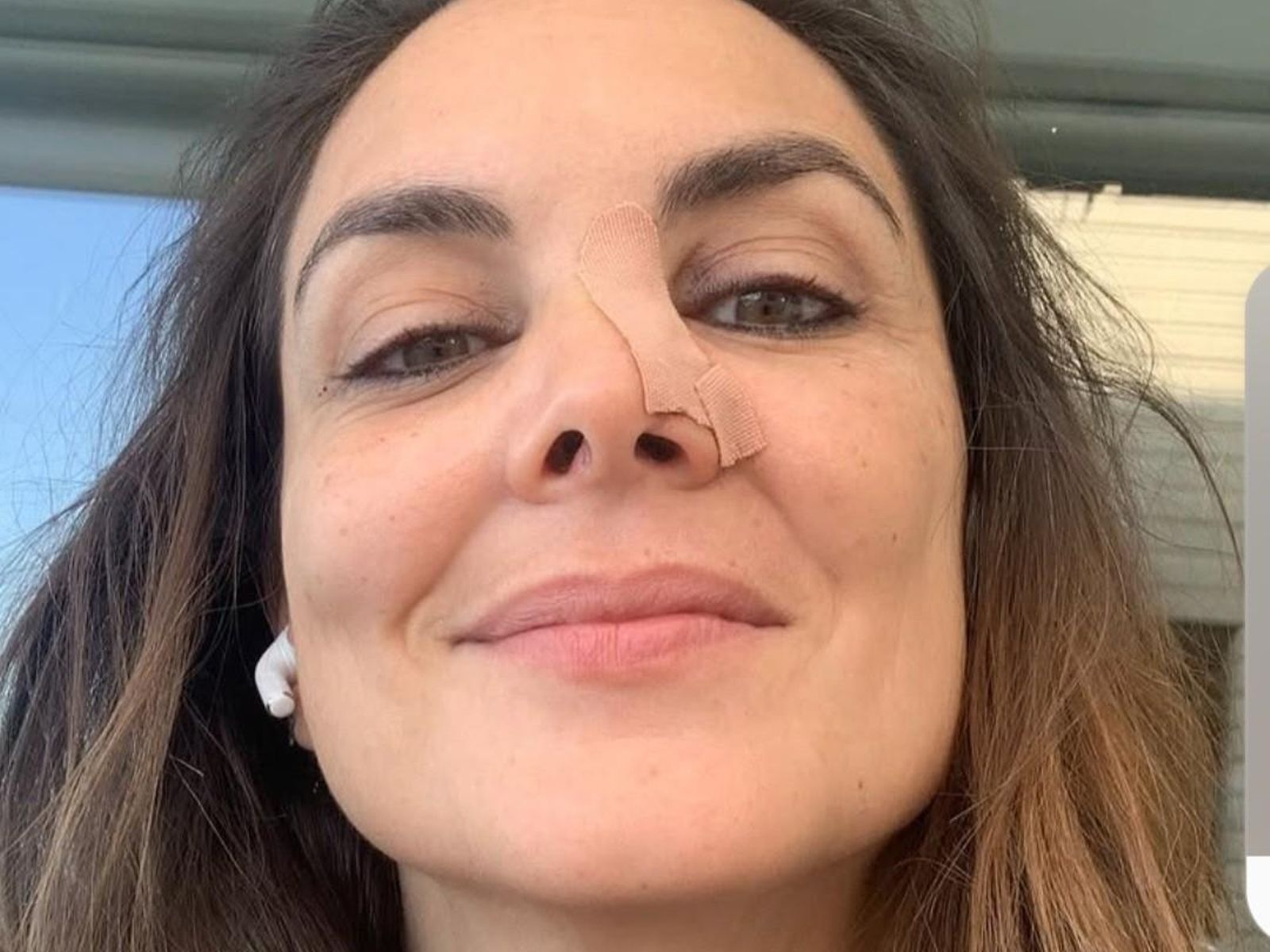 Mónica Carrillo con las secuelas de la intervención de un cáncer de piel en la nariz en 2020