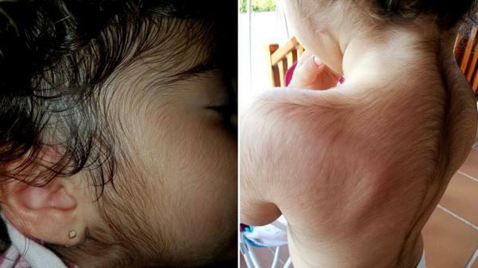Una niña aquejada de hipertricosis tras ingerir Omeprazol contaminado.