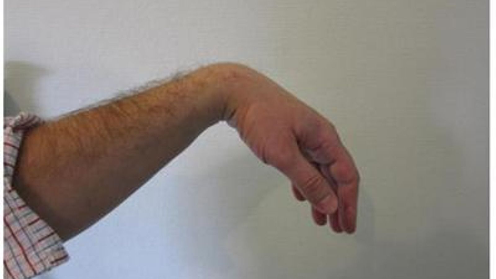 Ejemplo de mano péndula de un paciente en consulta