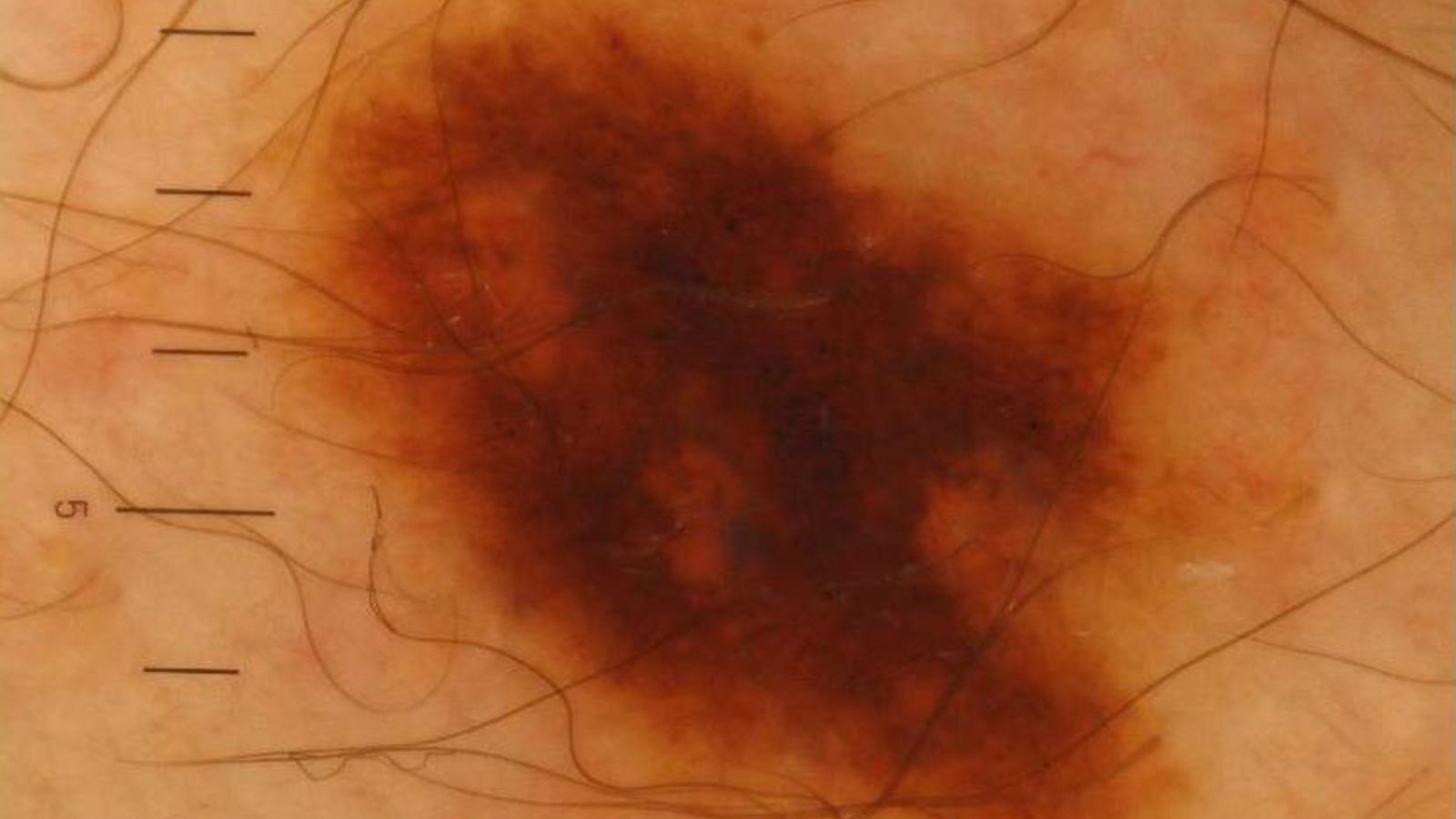 Tres tipos de seliones de piel que han sido incluidas en los algoritmos de Inteligencia Artificial del servicio de Dermatología en el Virgen del Rocío.