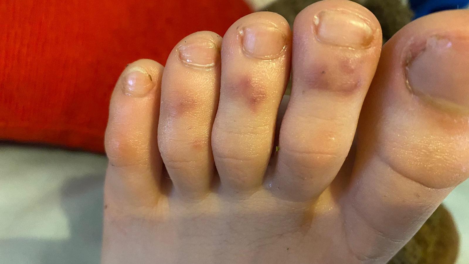 Las lesiones cutáneas provocadas por el Covid en los pies de un niño.