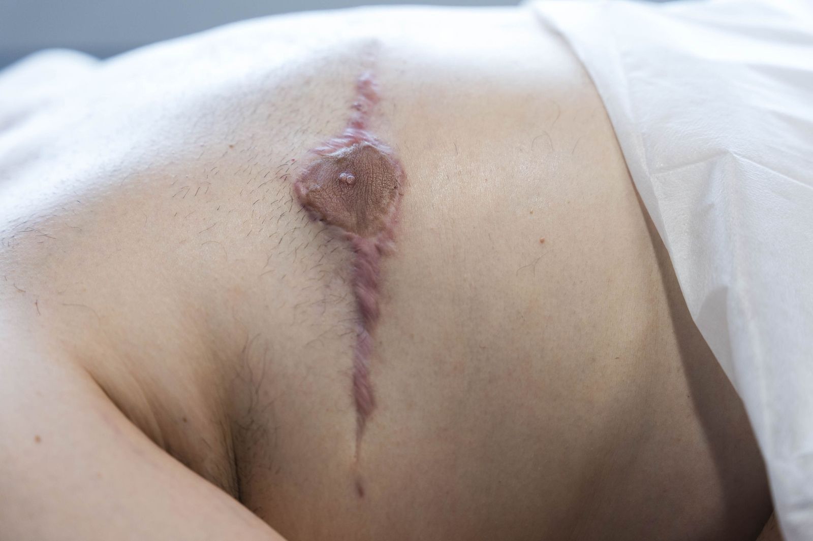 Un tratamiento de micropigmentación por mastectomía en un hombre, en imágenes