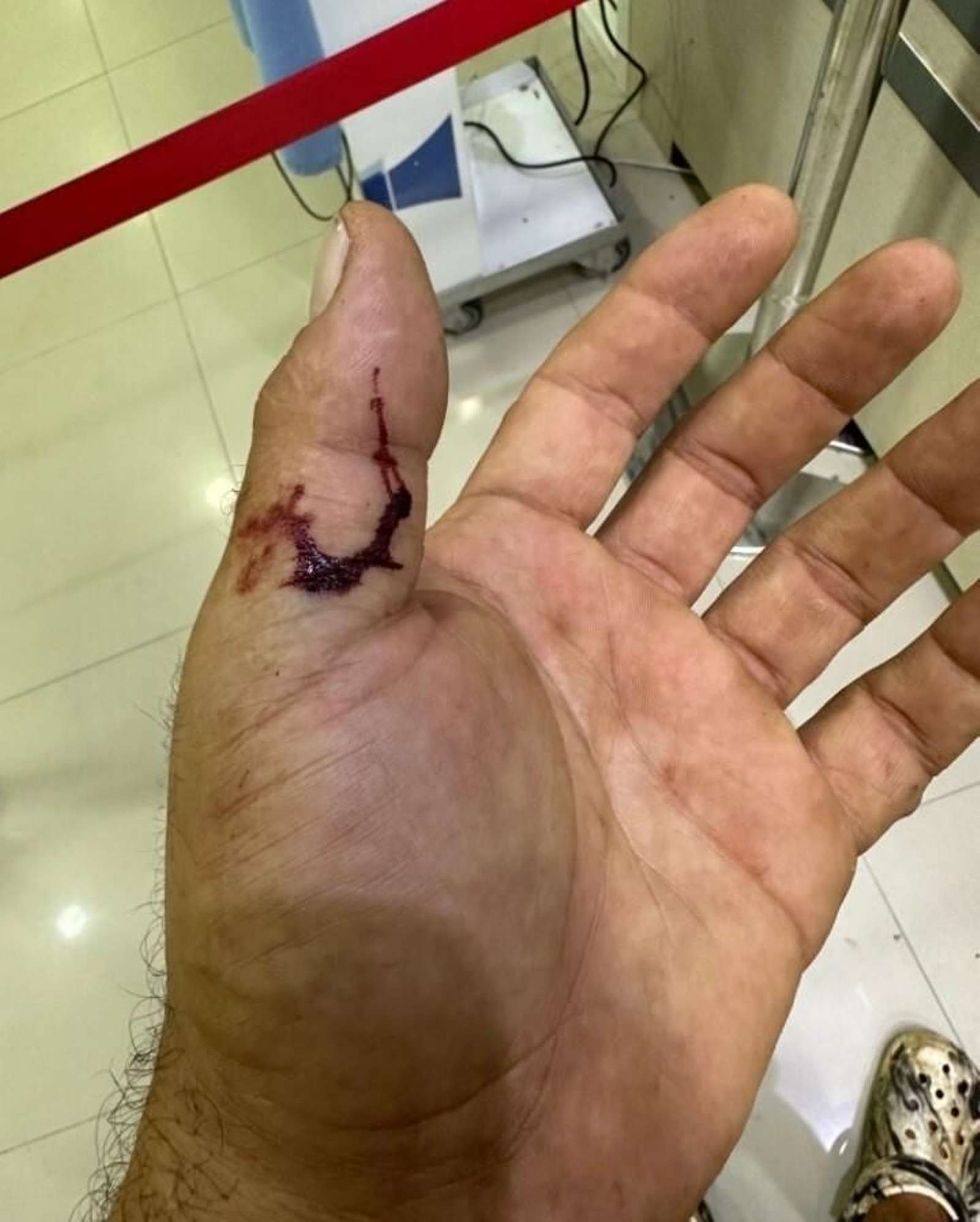 El estado en que tiene la mano Frank Cuesta por la picadura de la víbora