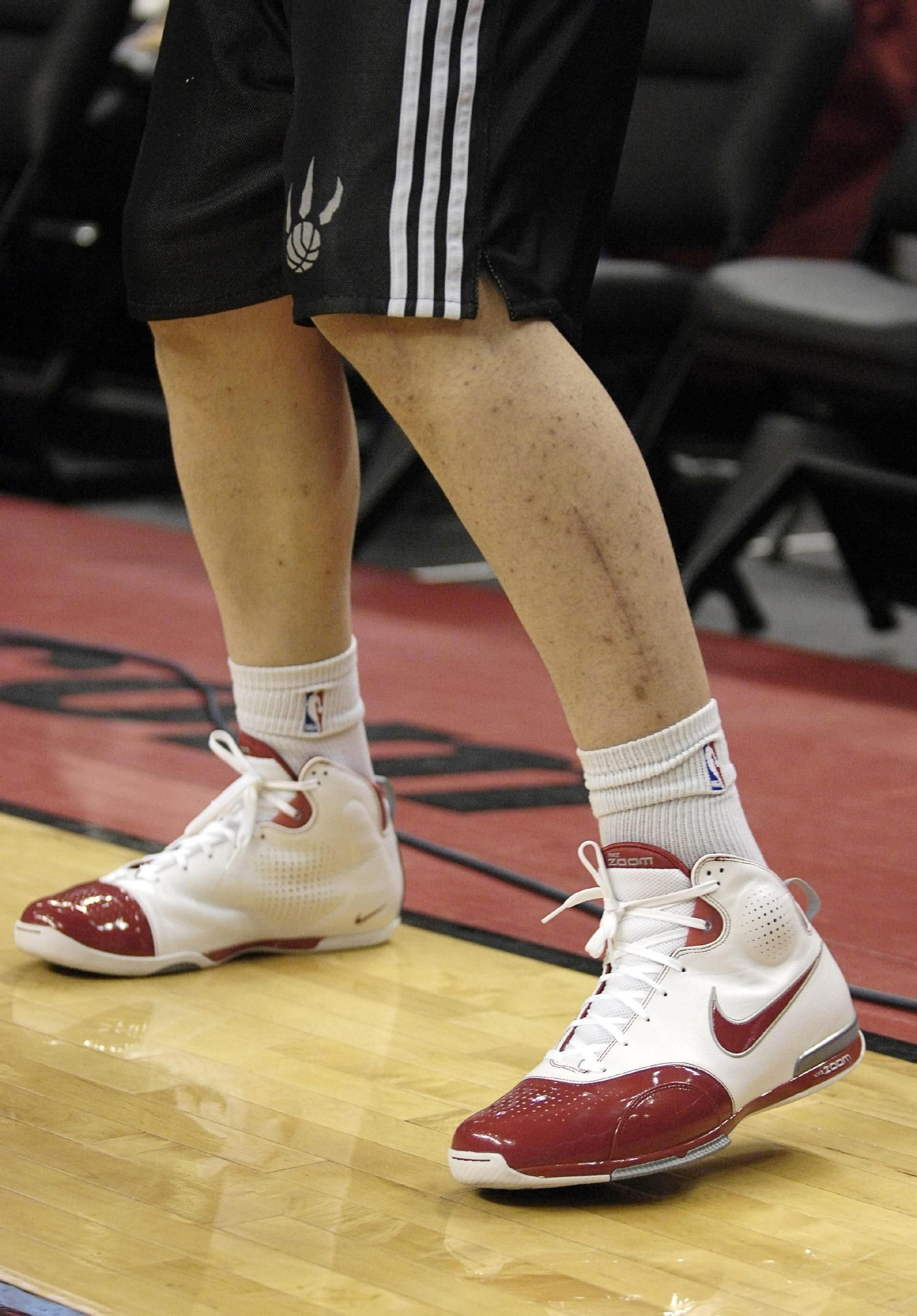 Cicatriz  en la pierna deJorge Garbajosa, cuando todavía jugaba enlos Raptors de Toronto.