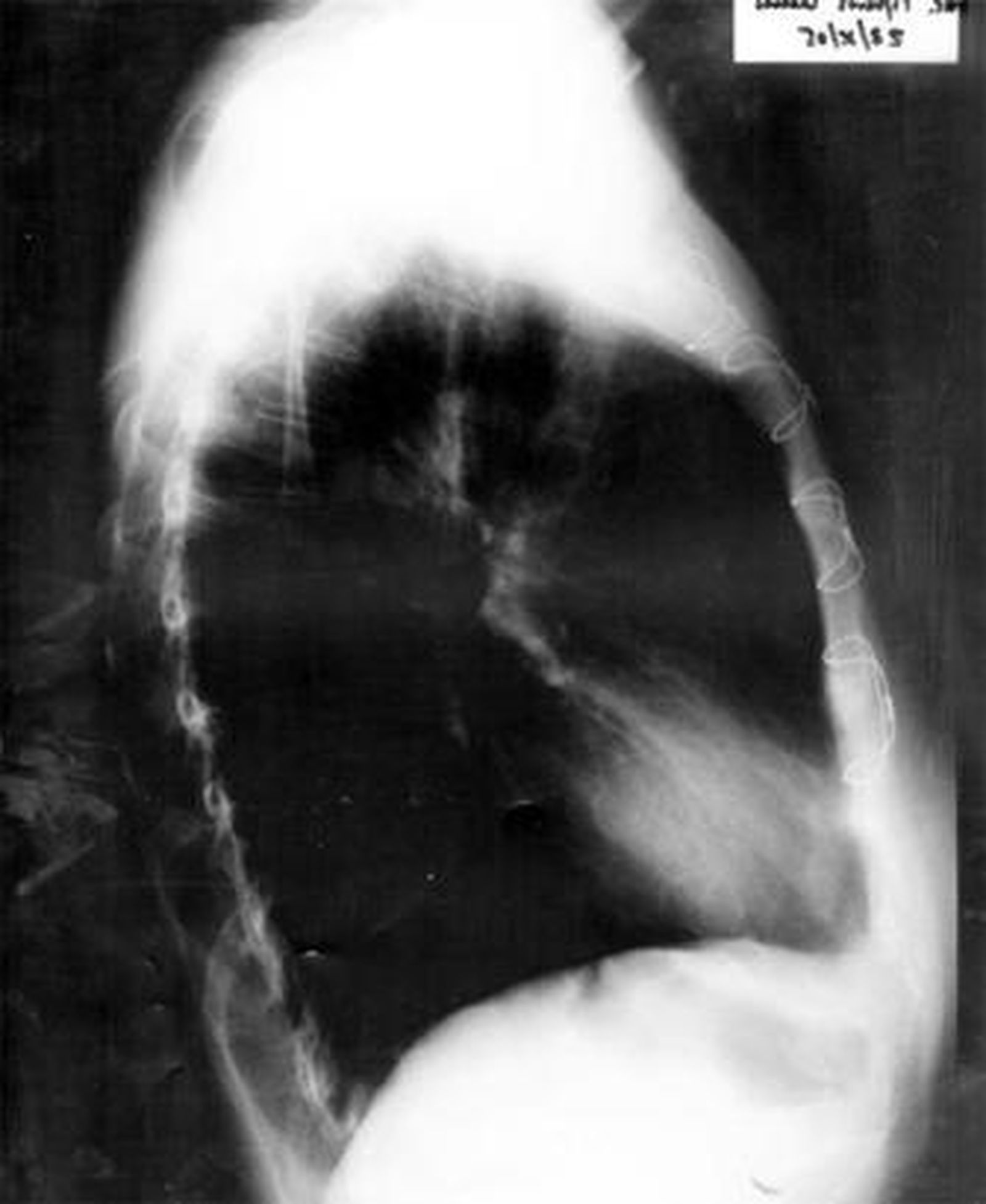 1. Imagen de las pruebas radiológicas realizadas a la paciente en las que se observa (en la ampliación) el cuerpo curvilíneo que resultó ser una aguja de sutura olvidada por el personal médico que le practicó la operación, en la que se intentó reparar el mal funcionamiento de la válvula mitral. Según los expertos, los objetos extraños son englobados por el organismo pero no se descarta que se mueva y tenga consecuencias.