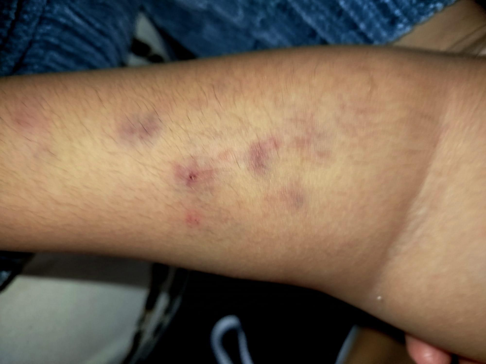 Los moratones en el brazo del menor, en una fotografía aportada por la madre.