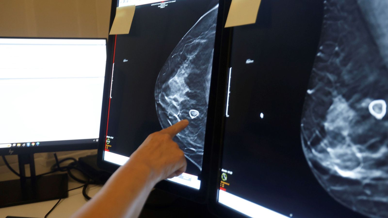 Imagen de archivo de una mamografía