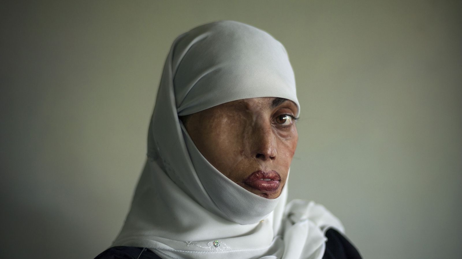 'Busha Shari, atacada con ácido por su marido. Islamabad. Pakistan 2008'.