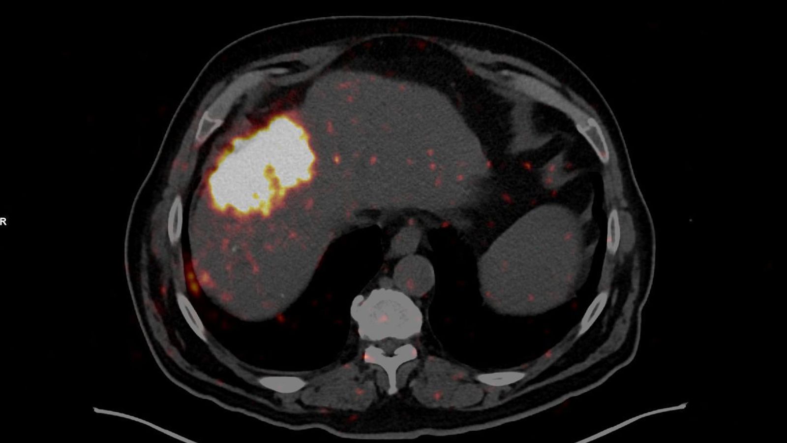 Terapia intervencionista para tratar un carcinoma hepatocelular