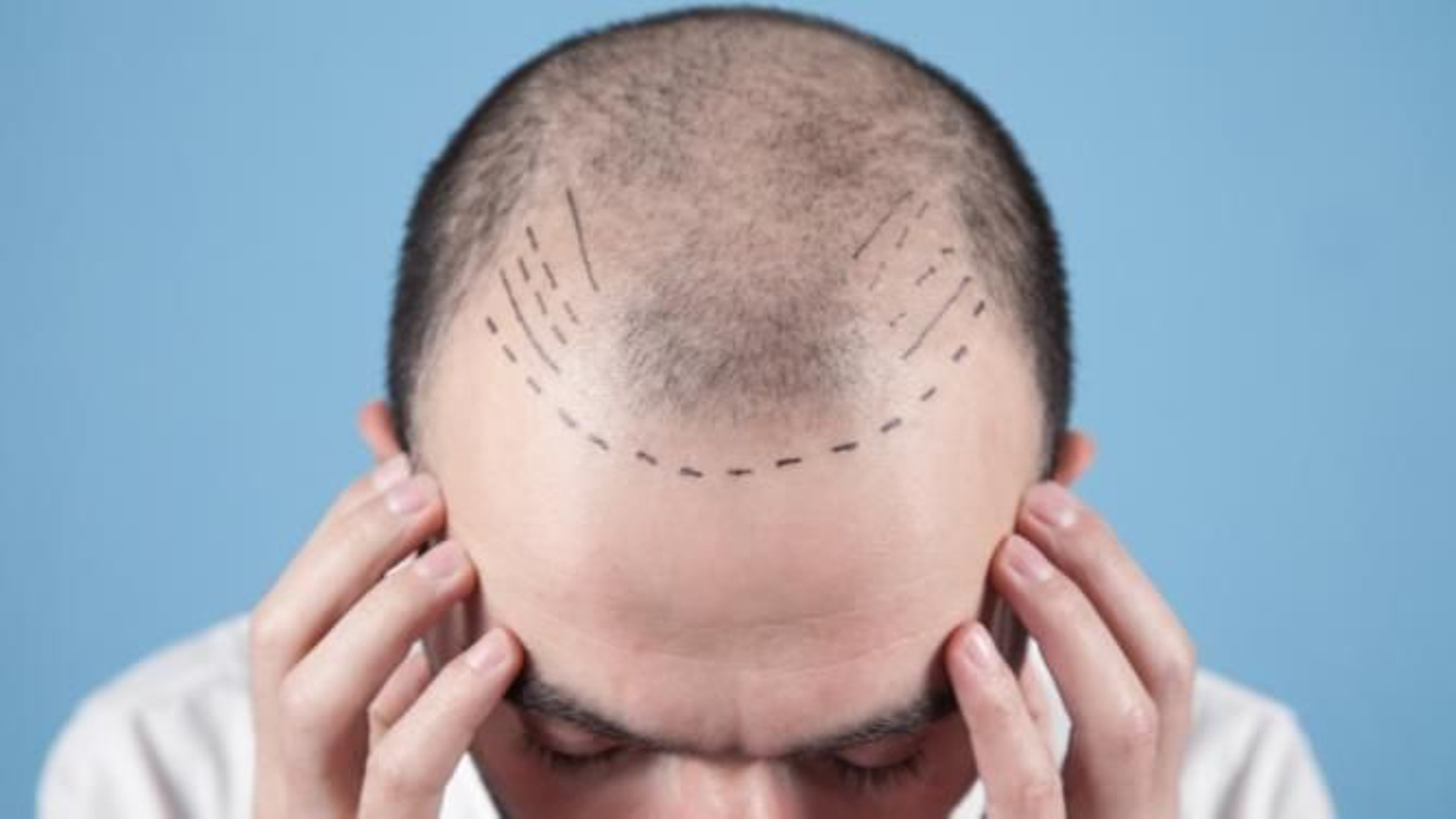 Imagen de una persona con alopecia. Imagen de una persona con alopecia.