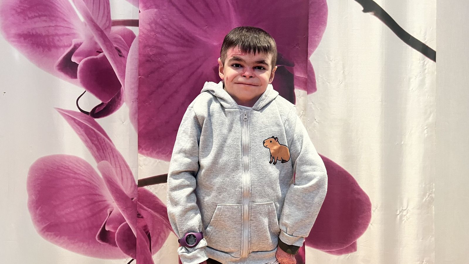 "Quiero poder hacer lo que quiera, sin que el dolor me lo impida": Leo y su lucha contra la piel de mariposa