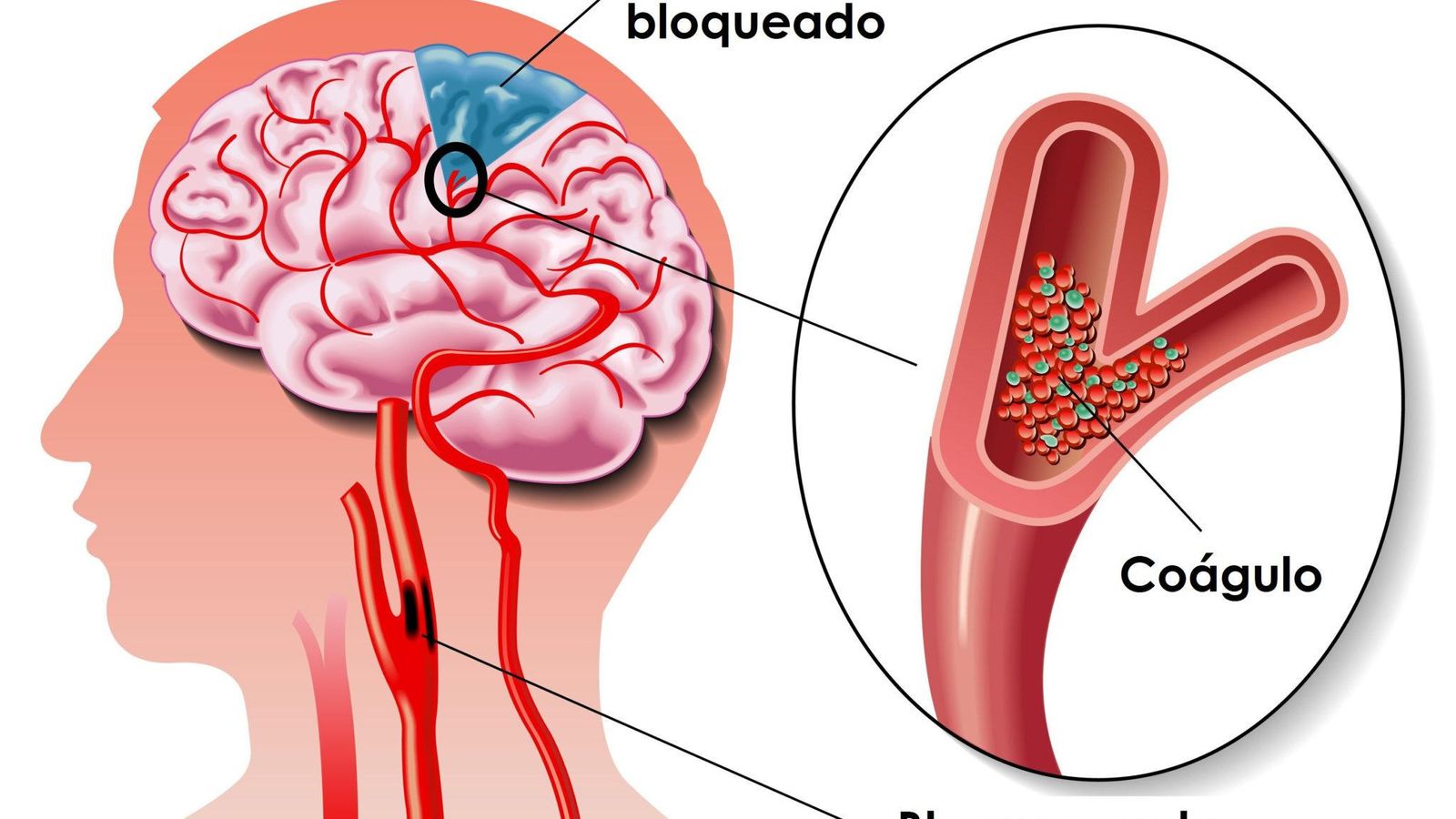 El ictus suele estar motivado por la formación de un coágulo de sangre o trombo en una arteria
