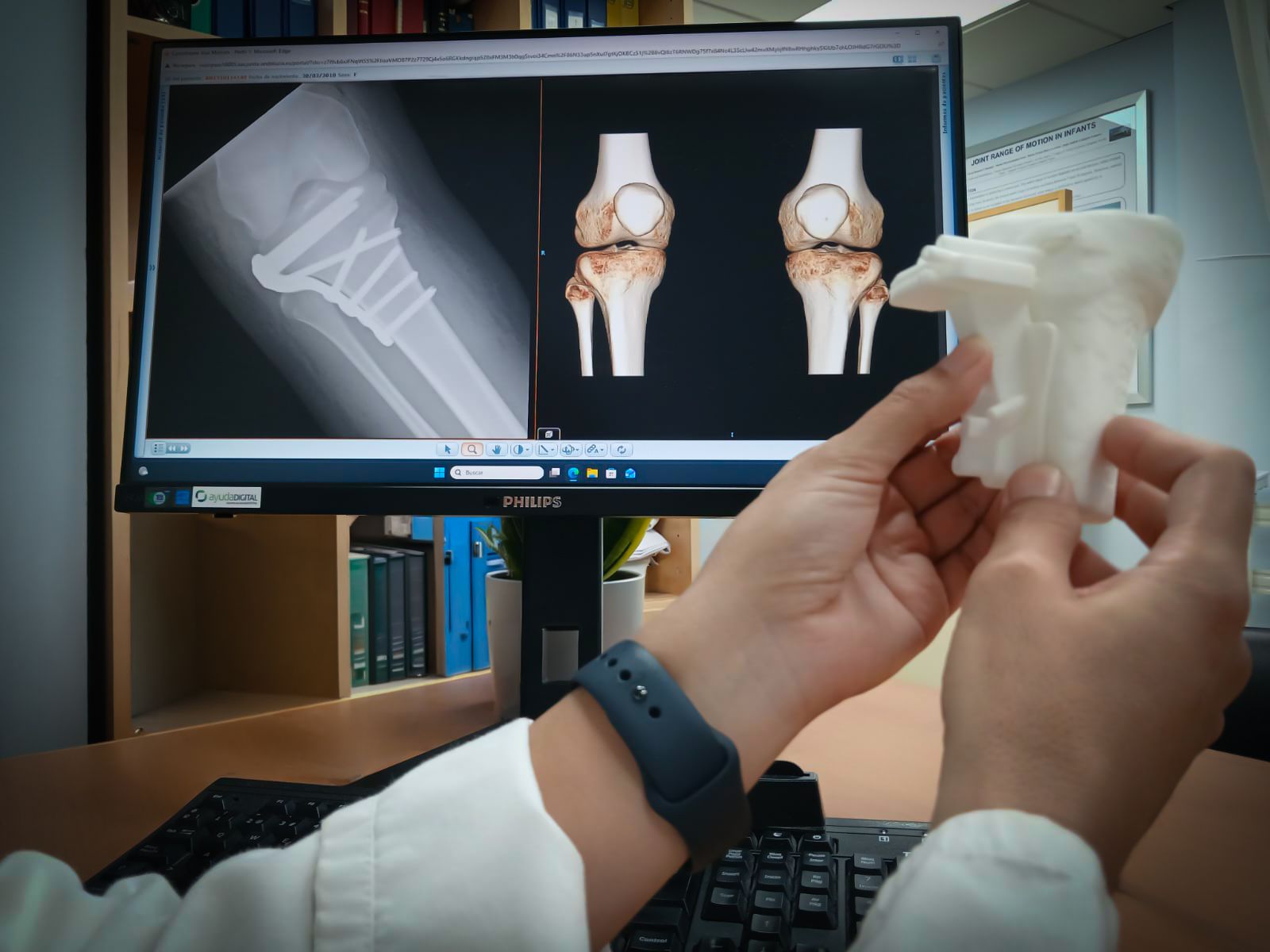 La traumatológa, Gloria Fernández, muestra en qué ha consistido la intervención.