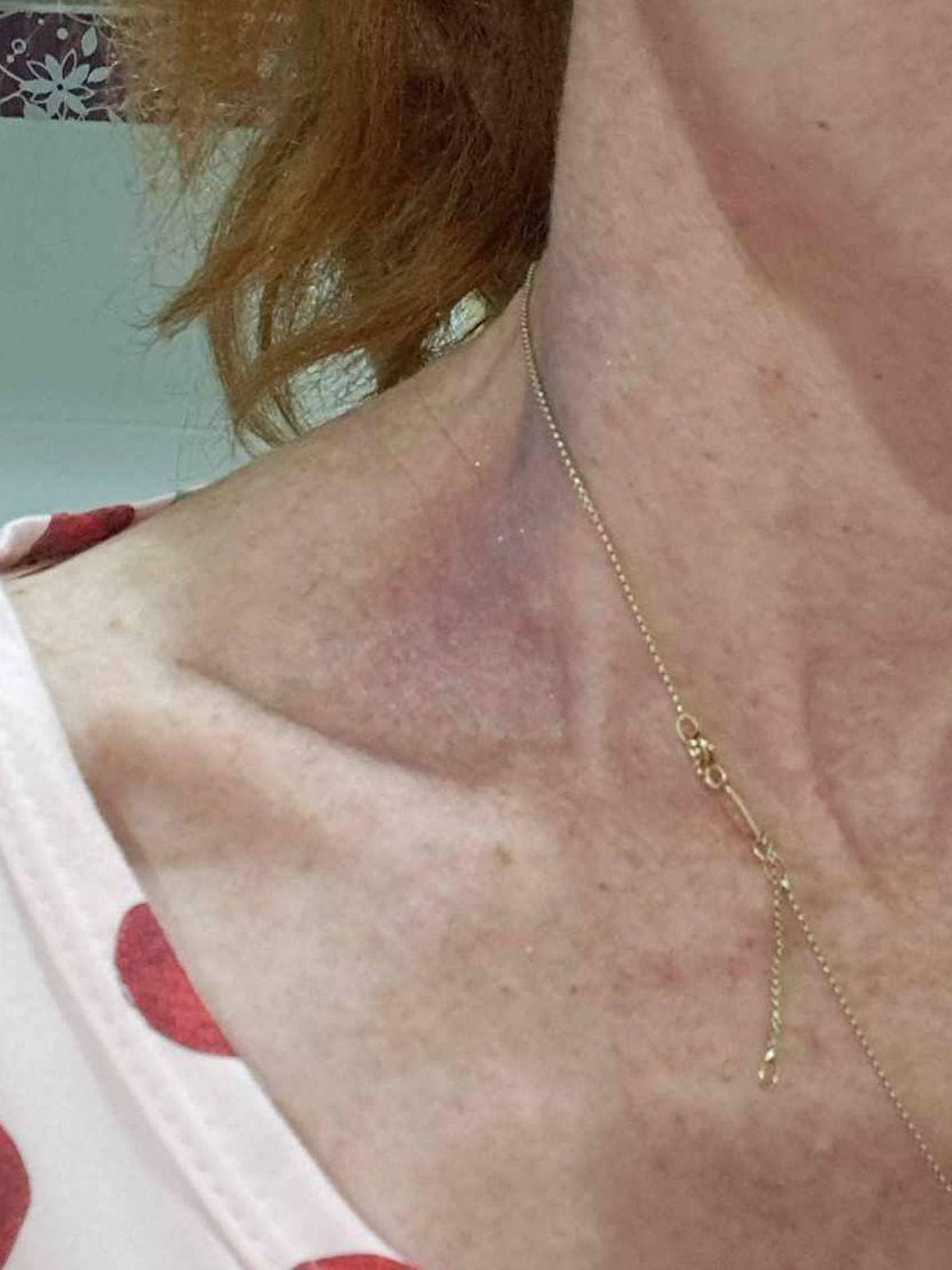 Hematoma en la base del cuello provocado por los golpes sufridos por la víctima, en una foto aportada por ella.