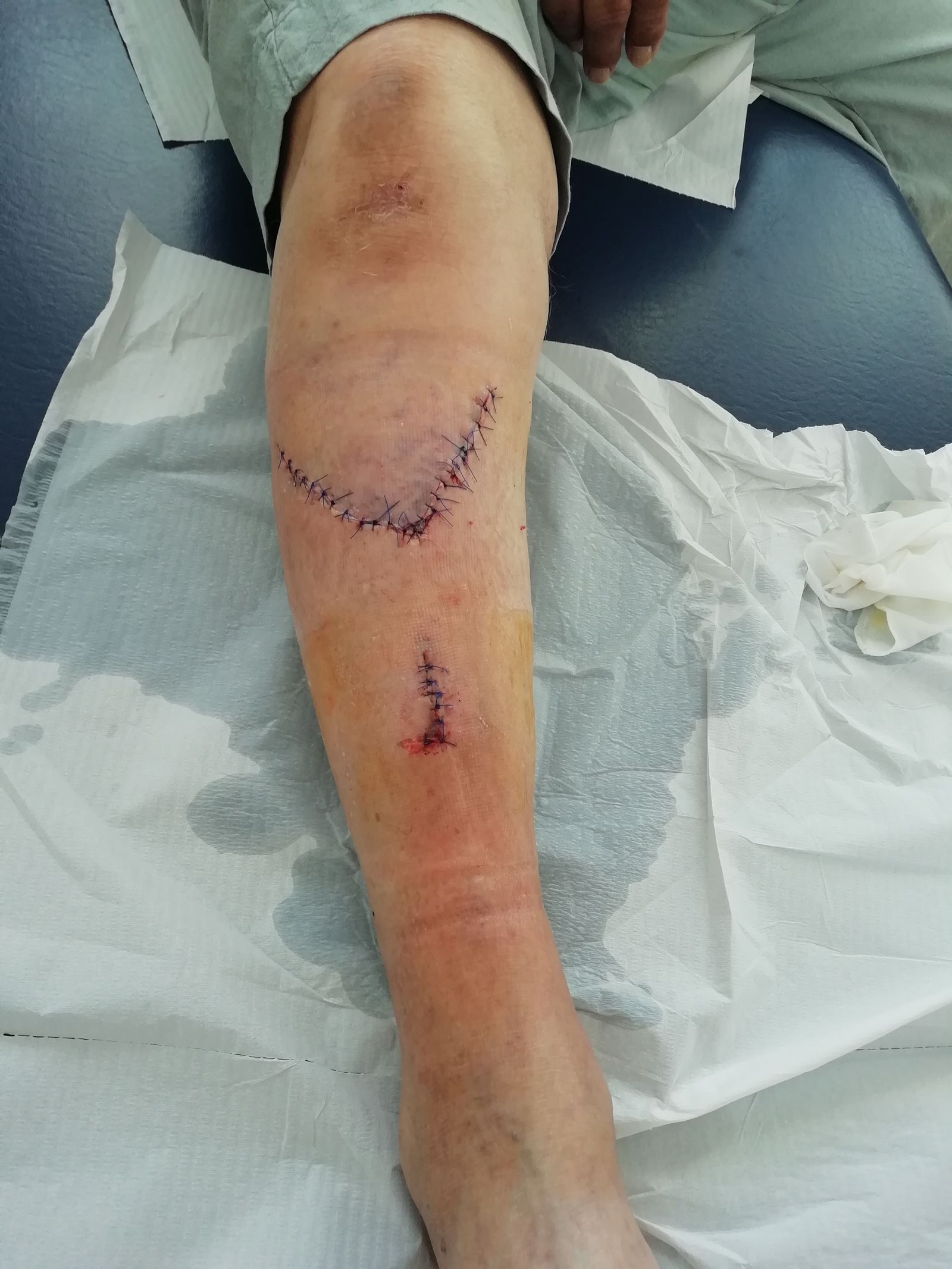 La herida del hombre tras ser asistido en el hospital.